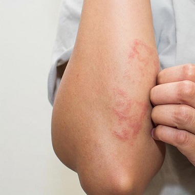 Cách phòng ngừa bệnh viêm da dị ứng khi trời hanh khô